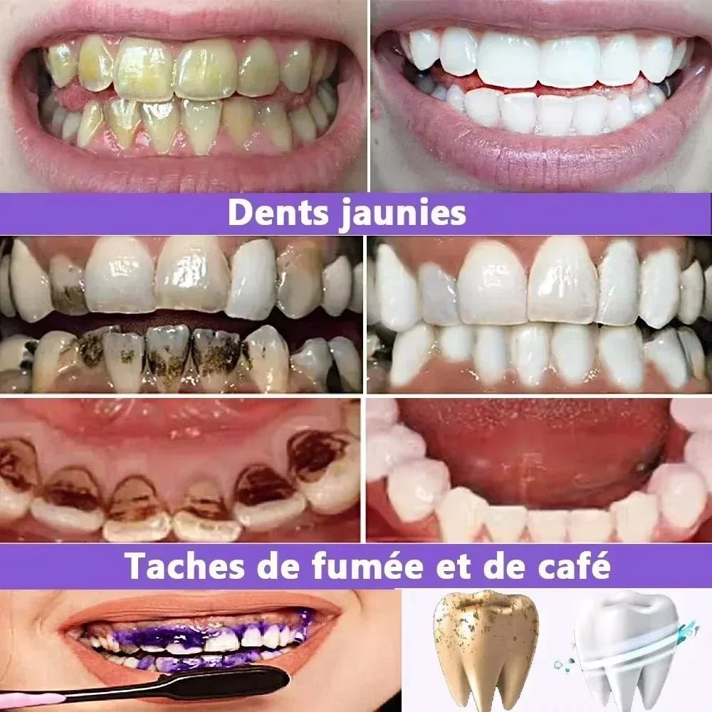 Stylo blanchisseur pour les dents - vente privée 14:1731PC