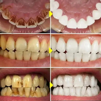 Stylo blanchisseur pour les dents - vente privée 14:1731PC