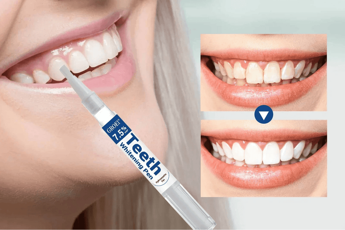 Stylo de blanchiment dentaire pour soins hygiène - vente privée 14:1735ML